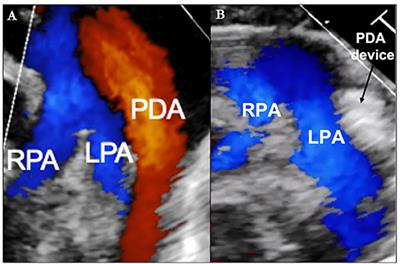 Management of Patent Ductus Arteriosus in Premature Infants in 2020